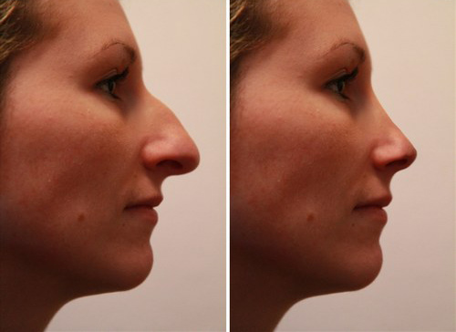 Rhinoplastie chirurgie esthetique du nez