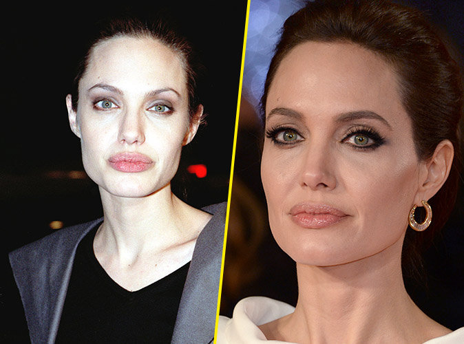 Angelina-Jolie-chirurgie-esthetique
