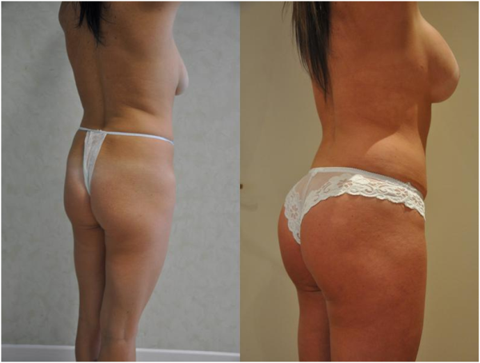 augmentation fesses plates