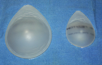 Types implants fessiers : augmentation fessier implant directionnel, rond, ...