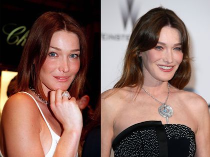 rhinoplastie-carla-bruni