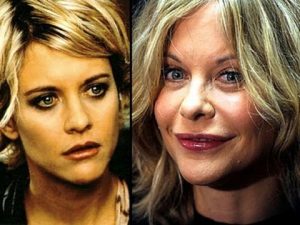 botox-Meg-Ryan