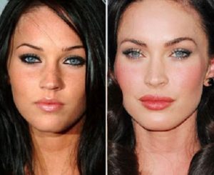 botox-Megan-Fox