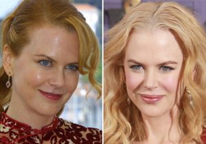 botox-Nicole-Kidman