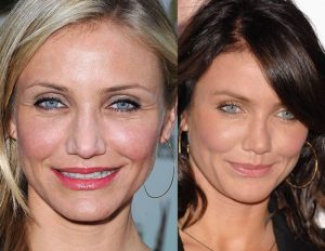 cameron-diaz-botox