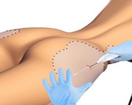 https://www.tunisie-chirurgie-esthetique.com/blog/wp-content/uploads/2018/02/liposuccion-au-laser-tunisie.jpg