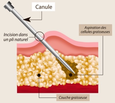 liposuccion canule