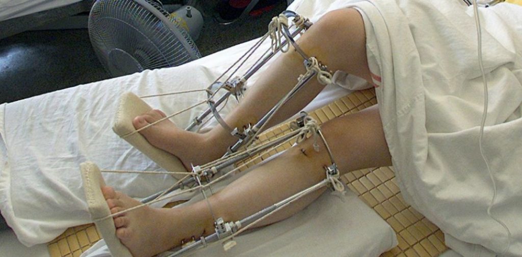 Chirurgie d'allongement des jambes : indication allongement osseux