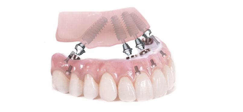 implants-dentaires-belgique