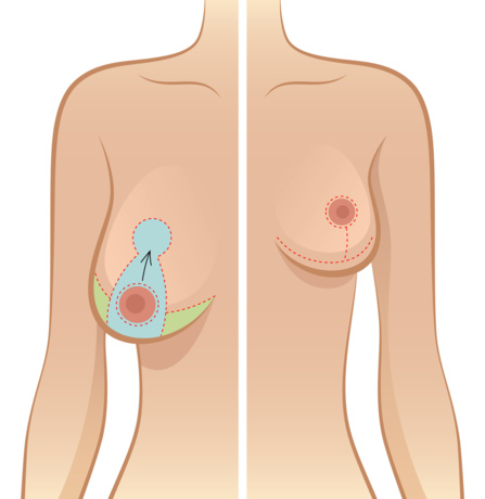 asymétrie mammaire causes
