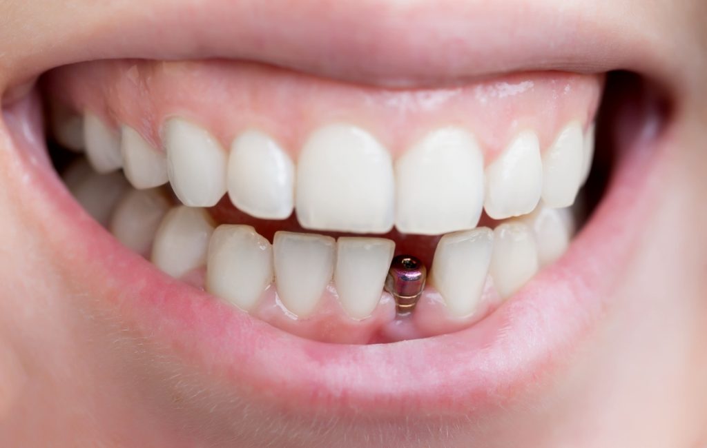 implant dentaire certifié