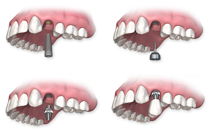 avantages-implants-dentaires