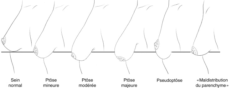 grades-ptose-mammaire