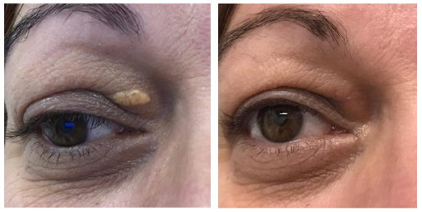 Résultat elimination-xanthelasma-avant-apres