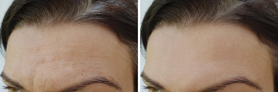 resultat-endotine-lifting-front-sourcils