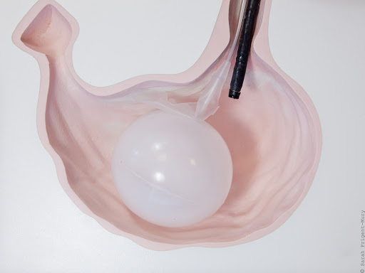 Ballon-intragastrique-endoscopique
