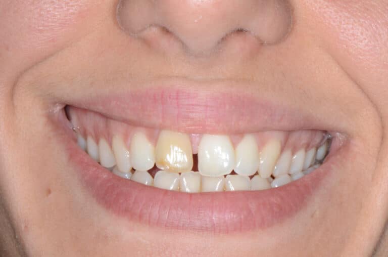 Éclaircir la couleur des dents qui ont perdu leur vitalité