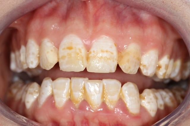 fluorose-dentaire