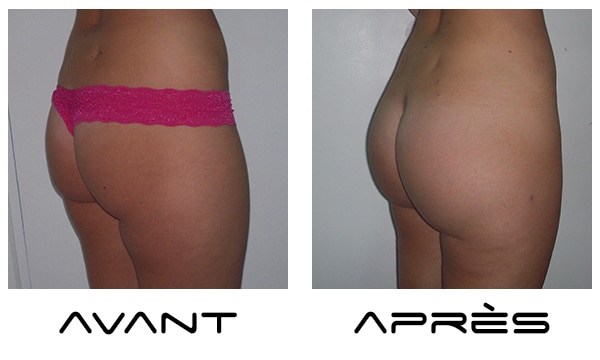 resultat augmentation fesses plates