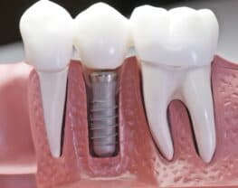 implants dentaire Hongrie