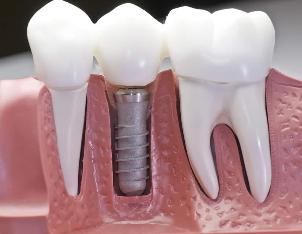 implants dentaire Hongrie