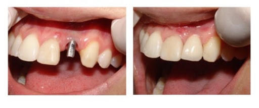 resultat-implant-dentaire-Hongrie