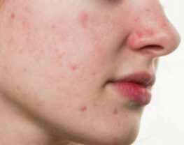 traitement-acne-dadulte