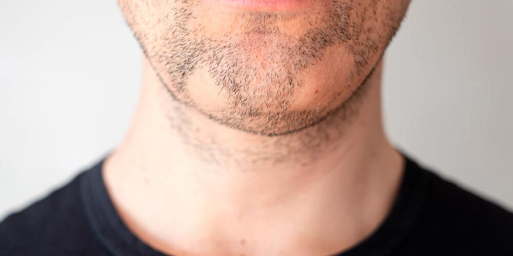 traitements-alopecie-barbae