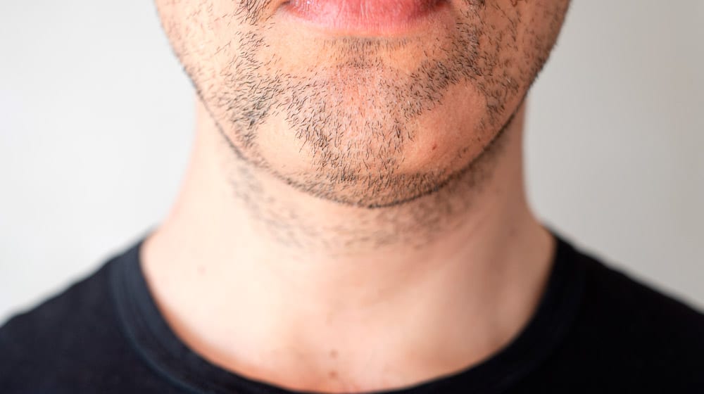traitements-alopecie-barbae