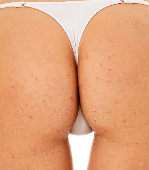 eliminer-acne-fesses