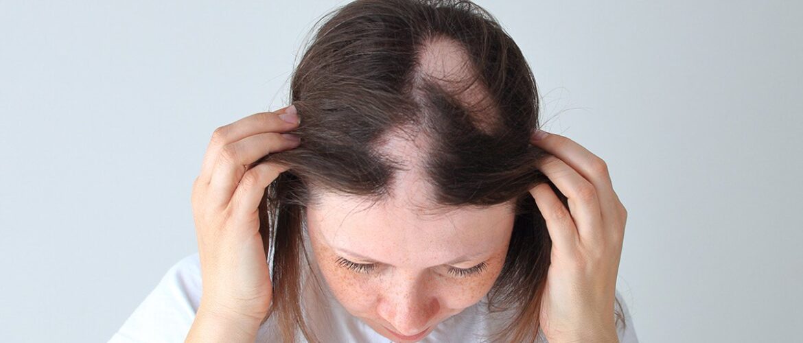 Olumiant-traitement-alopecie