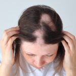 Olumiant-traitement-alopecie