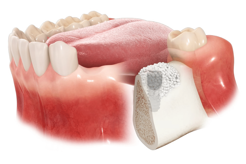 greffe-osseuse-dentaire