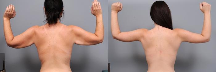resultat-lifting-bras-avant-apres