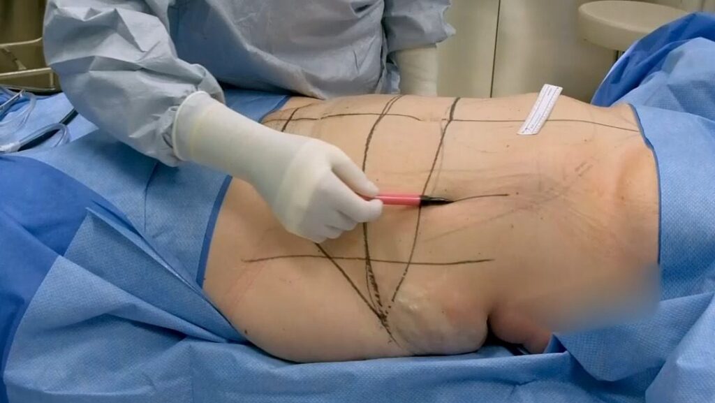 Abdominoplastie