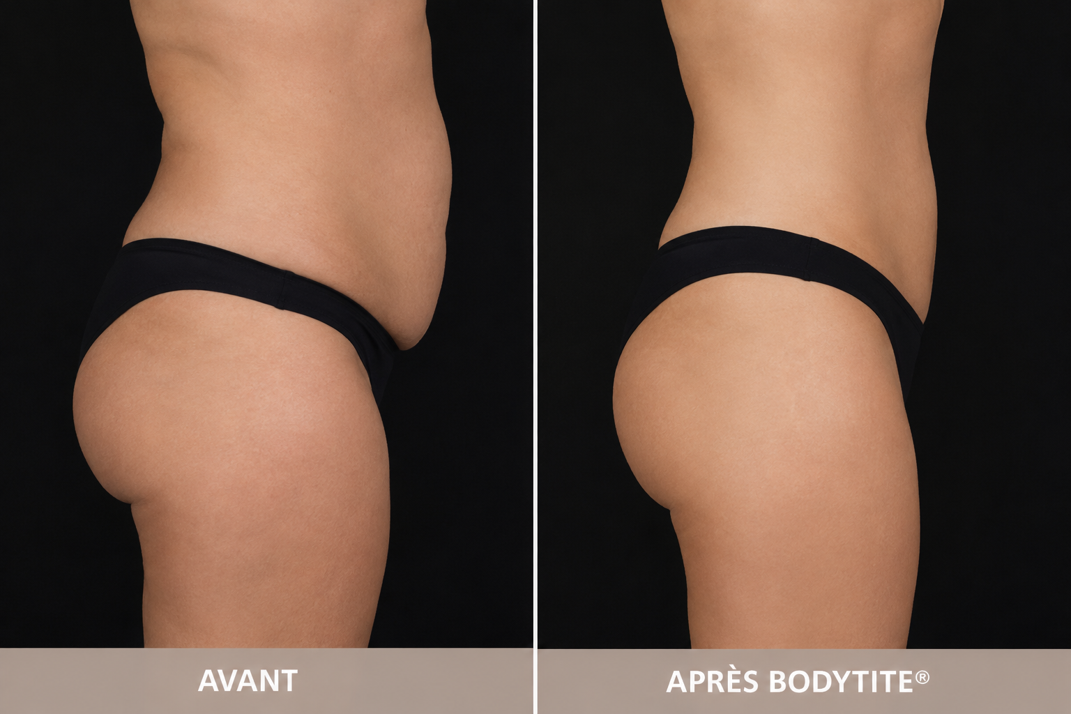 resultat-bodytite-avant-apres