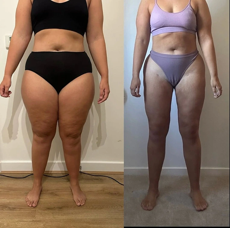 Lipedema Liposculpture Approach