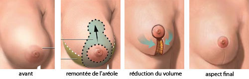 deroulement reduction mammaire Tunisie