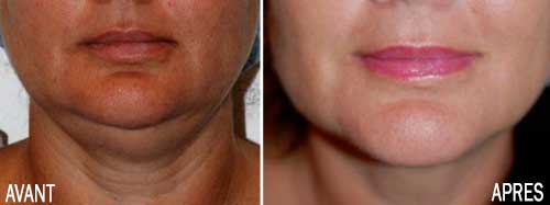 liposuccion cou visage