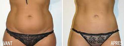 liposuccion ventre tunisie