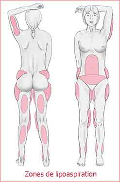 zones liposuccion