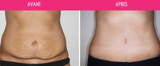 Abdominoplastie, chirurgie de la paroi abdominale Tunisie