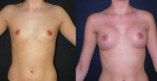 photo avant après augmentation mammaire implant