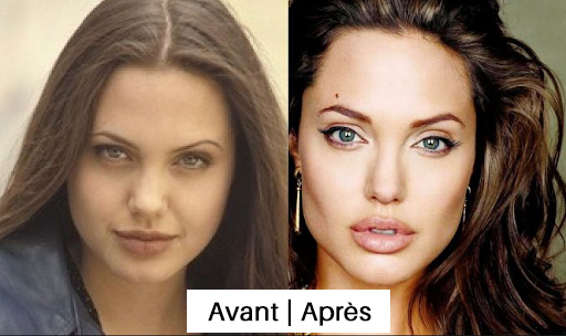 Bichectomie Angelina Jolie avant après