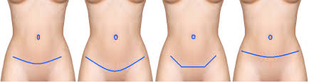 type cicatrices abdominoplastie