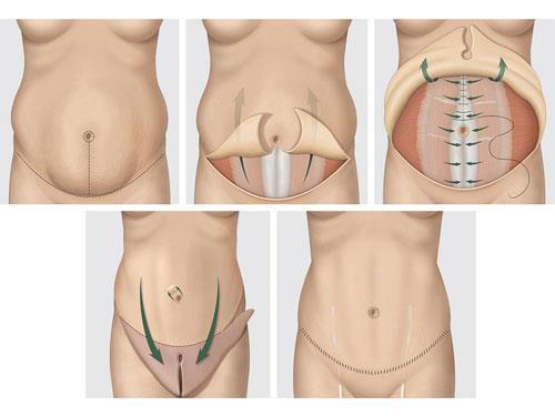 etapes abdominoplastie Tunisie