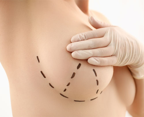 deroulement reduction mammaire Tunisie