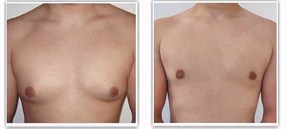 Gynecomastie Tunisie