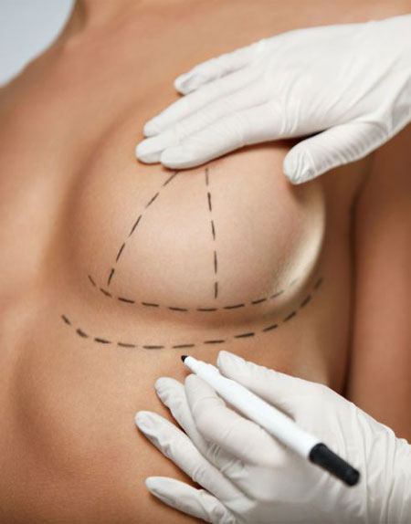 incisions lifting seins mastopexie Tunisie