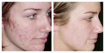 Traitement laser cicatrices acne tunisie